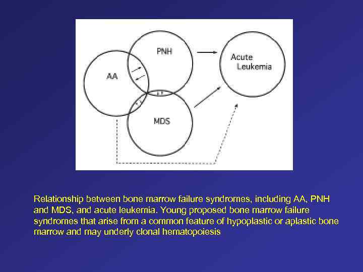 Relationship between bone marrow failure syndromes, including AA, PNH and MDS, and acute leukemia.