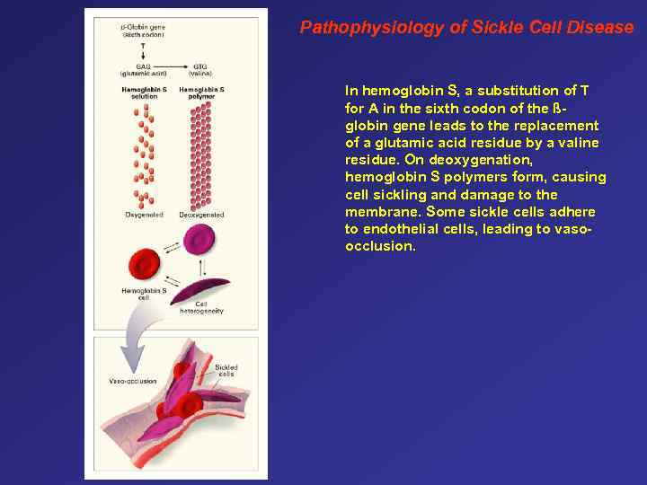 Pathophysiology of Sickle Cell Disease In hemoglobin S, a substitution of T for A