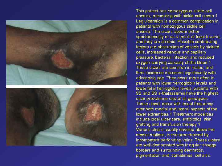 This patient has homozygous sickle cell anemia, presenting with sickle cell ulcers. 1 Leg