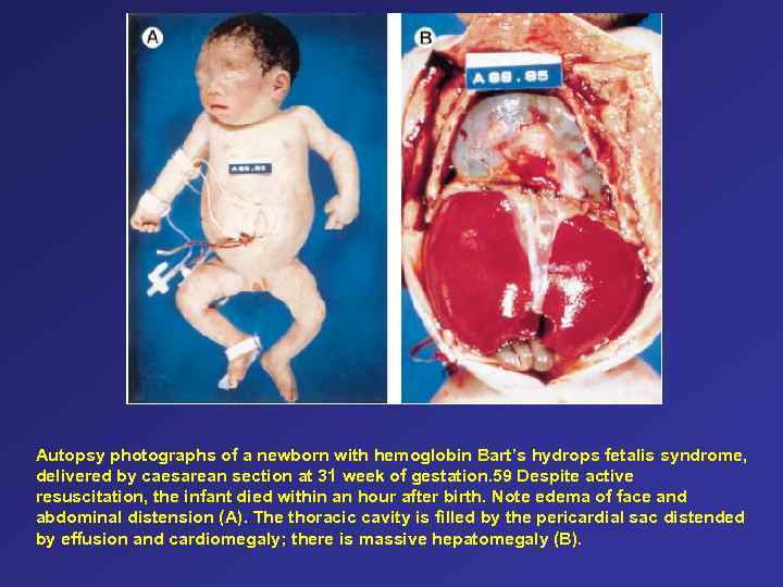 Autopsy photographs of a newborn with hemoglobin Bart’s hydrops fetalis syndrome, delivered by caesarean