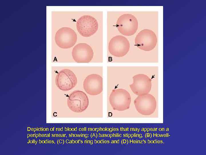 Depiction of red blood cell morphologies that may appear on a peripheral smear, showing: