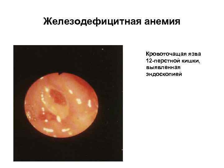 Железодефицитная анемия Кровоточащая язва 12 -перстной кишки, выявленная эндоскопией 