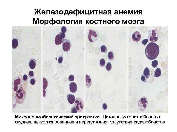 Железодефицитная анемия Морфология костного мозга Микронормобластический эритропоэз. Цитоплазма эритробластов скудная, вакуолизированная и нерегулярная, отсутствие