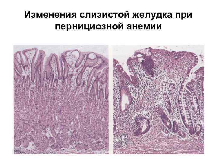 Изменения слизистой желудка при пернициозной анемии 