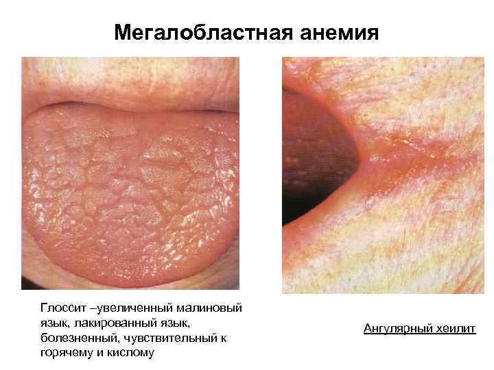 Мегалобластная анемия Глоссит –увеличенный малиновый язык, лакированный язык, болезненный, чувствительный к горячему и кислому