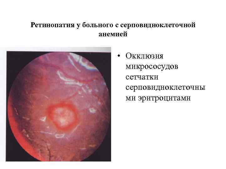 Ретинопатия у больного с серповидноклеточной анемией • Окклюзия микрососудов сетчатки серповидноклеточны ми эритроцитами 