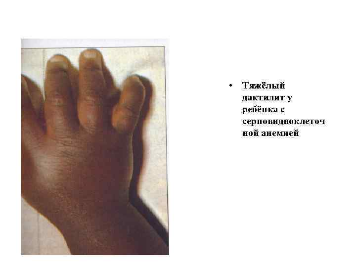  • Тяжёлый дактилит у ребёнка с серповидноклеточ ной анемией 