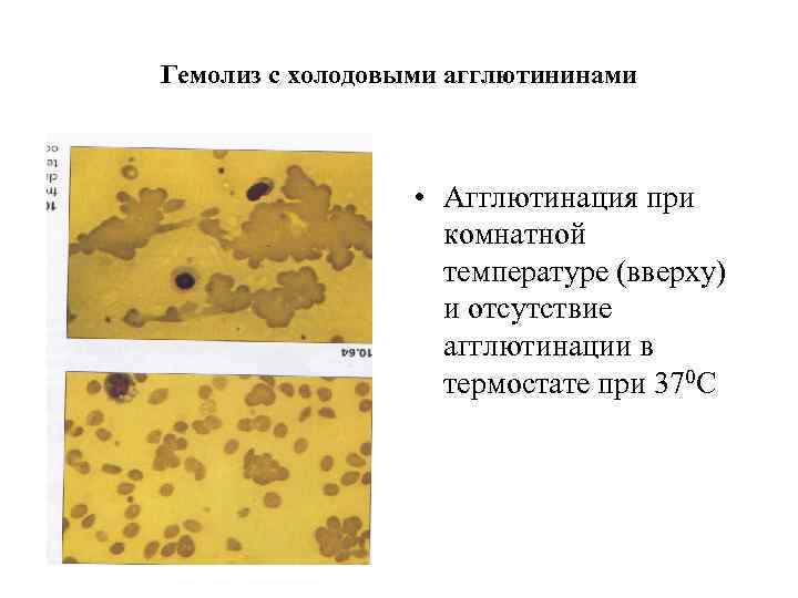 Холодовые агглютинины фото