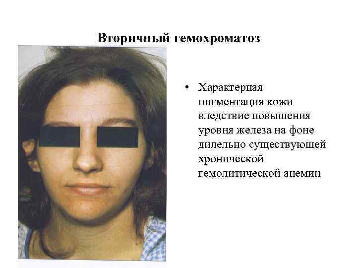 Вторичный гемохроматоз • Характерная пигментация кожи вледствие повышения уровня железа на фоне дилельно существующей
