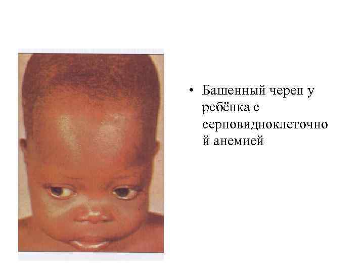  • Башенный череп у ребёнка с серповидноклеточно й анемией 