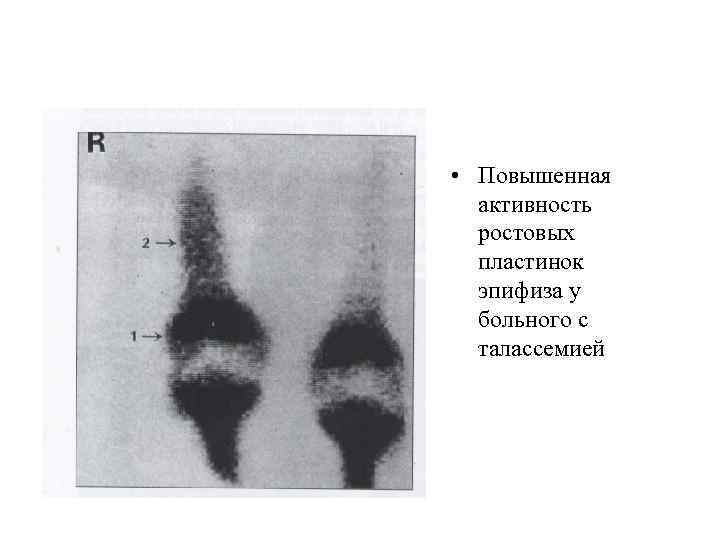  • Повышенная активность ростовых пластинок эпифиза у больного с талассемией 