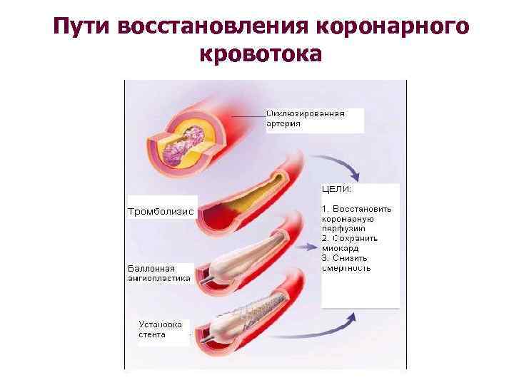 Пути восстановления коронарного кровотока 