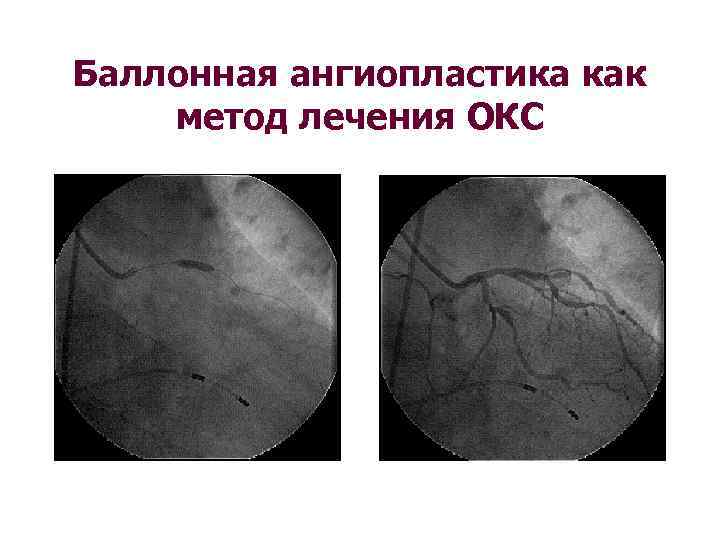 Баллонная ангиопластика как метод лечения ОКС 