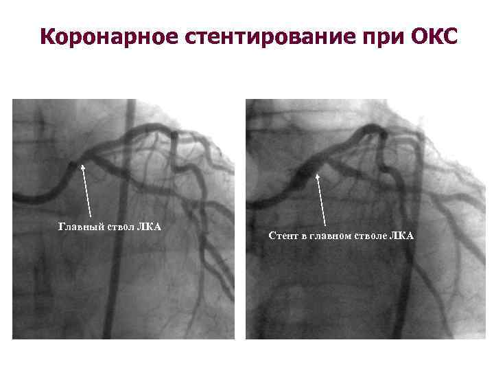 Коронарное стентирование при ОКС Главный ствол ЛКА Стент в главном стволе ЛКА 