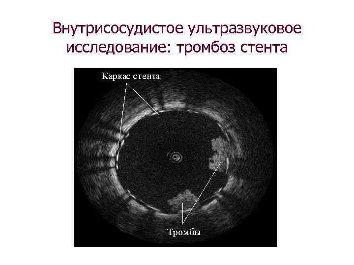 Внутрисосудистое ультразвуковое исследование: тромбоз стента Каркас стента Тромбы 