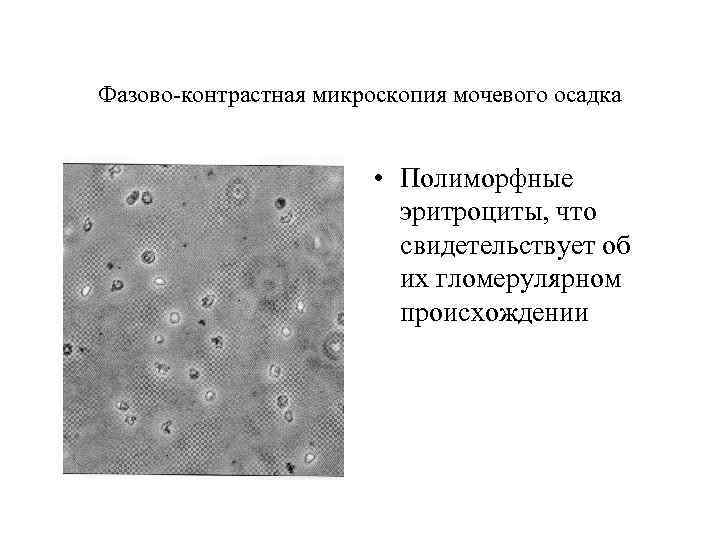 Фазово-контрастная микроскопия мочевого осадка • Полиморфные эритроциты, что свидетельствует об их гломерулярном происхождении 