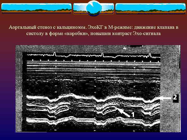 Аортальный стеноз с кальцинозом. Эхо. КГ в М-режиме: движение клапана в систолу в форме