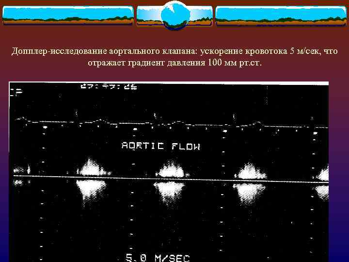 Допплер-исследование аортального клапана: ускорение кровотока 5 м/сек, что отражает градиент давления 100 мм рт.