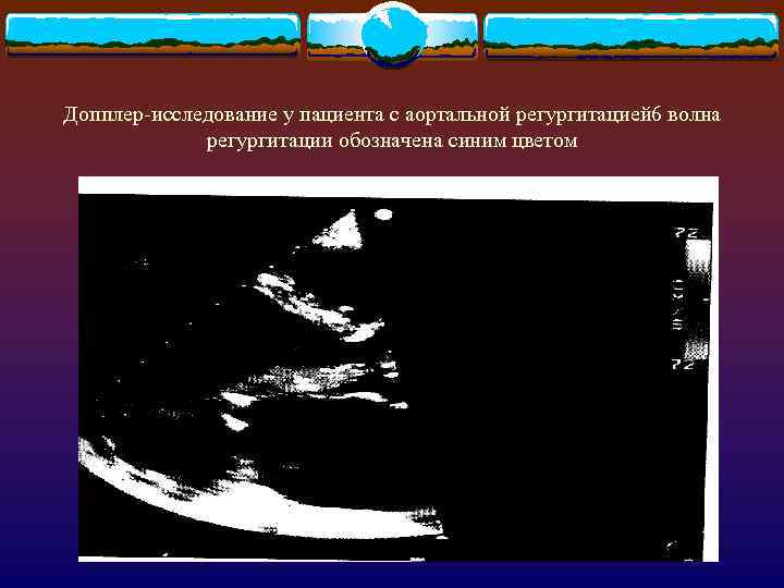 Допплер-исследование у пациента с аортальной регургитацией 6 волна регургитации обозначена синим цветом 