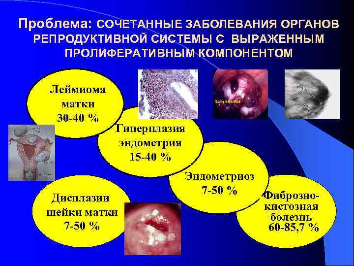 Проблема: СОЧЕТАННЫЕ ЗАБОЛЕВАНИЯ ОРГАНОВ РЕПРОДУКТИВНОЙ СИСТЕМЫ С ВЫРАЖЕННЫМ ПРОЛИФЕРАТИВНЫМ КОМПОНЕНТОМ Леймиома матки 30 -40