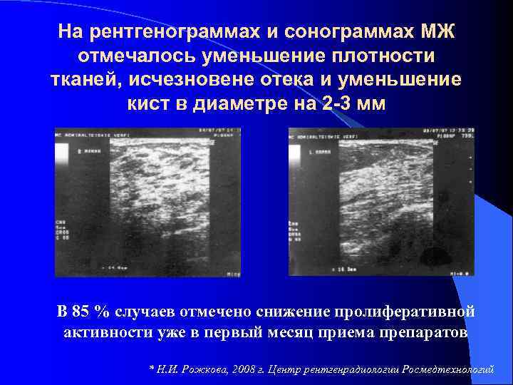 На рентгенограммах и сонограммах МЖ отмечалось уменьшение плотности тканей, исчезновене отека и уменьшение кист