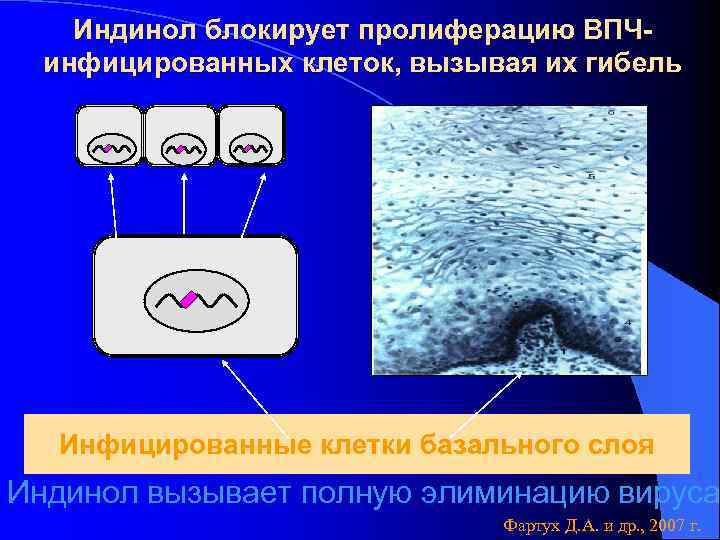 Индинол блокирует пролиферацию ВПЧинфицированных клеток, вызывая их гибель Инфицированные клетки базального слоя Индинол вызывает