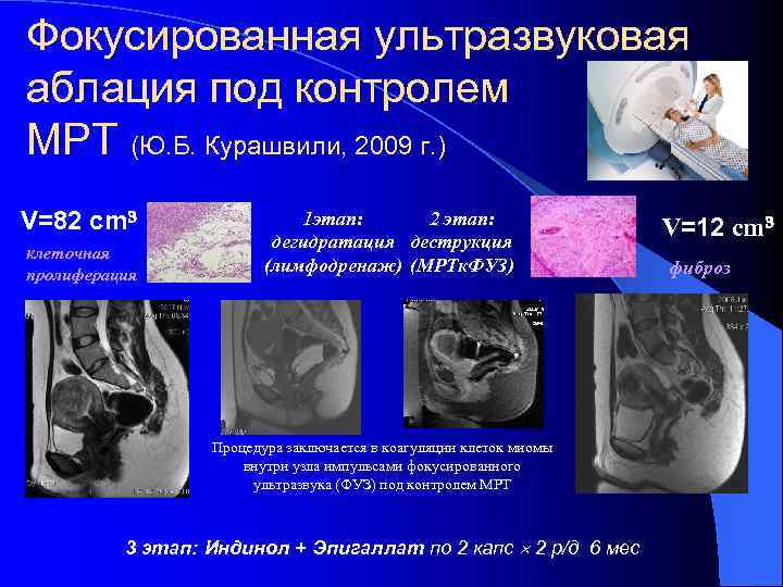 Фокусированная ультразвуковая аблация под контролем МРТ (Ю. Б. Курашвили, 2009 г. ) V=82 cm³