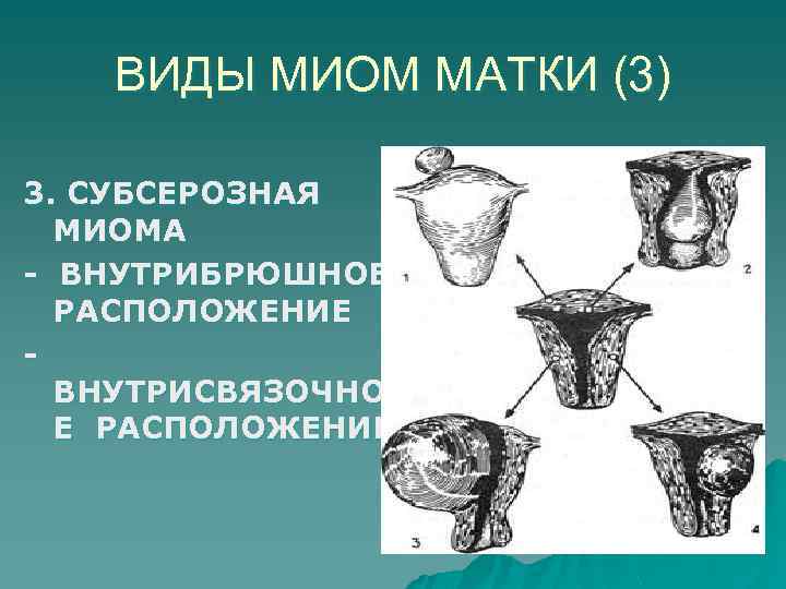 Типы миом. Разновидности миомы матки. Виды миом матки по расположению.