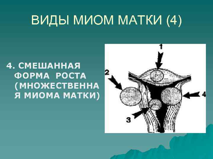 ВИДЫ МИОМ МАТКИ (4) 4. СМЕШАННАЯ ФОРМА РОСТА (МНОЖЕСТВЕННА Я МИОМА МАТКИ) 