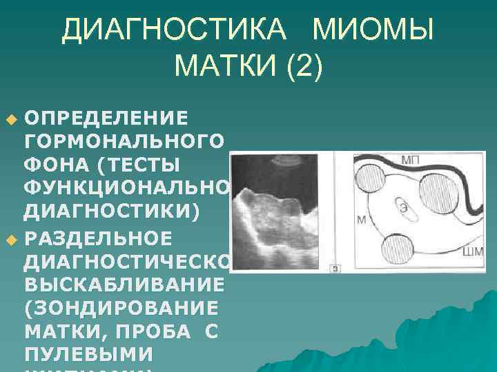 ДИАГНОСТИКА МИОМЫ МАТКИ (2) ОПРЕДЕЛЕНИЕ ГОРМОНАЛЬНОГО ФОНА (ТЕСТЫ ФУНКЦИОНАЛЬНОЙ ДИАГНОСТИКИ) u РАЗДЕЛЬНОЕ ДИАГНОСТИЧЕСКОЕ ВЫСКАБЛИВАНИЕ