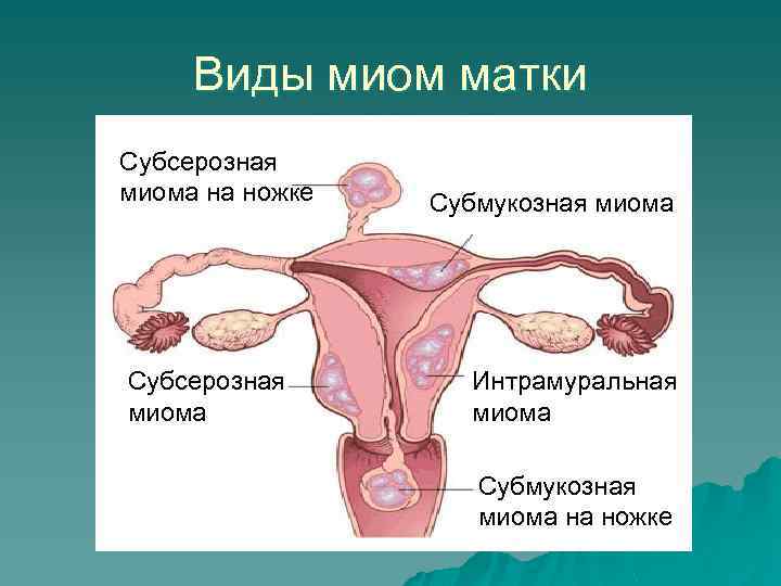 Виды миом матки Субсерозная миома на ножке Субсерозная миома Субмукозная миома Интрамуральная миома Субмукозная