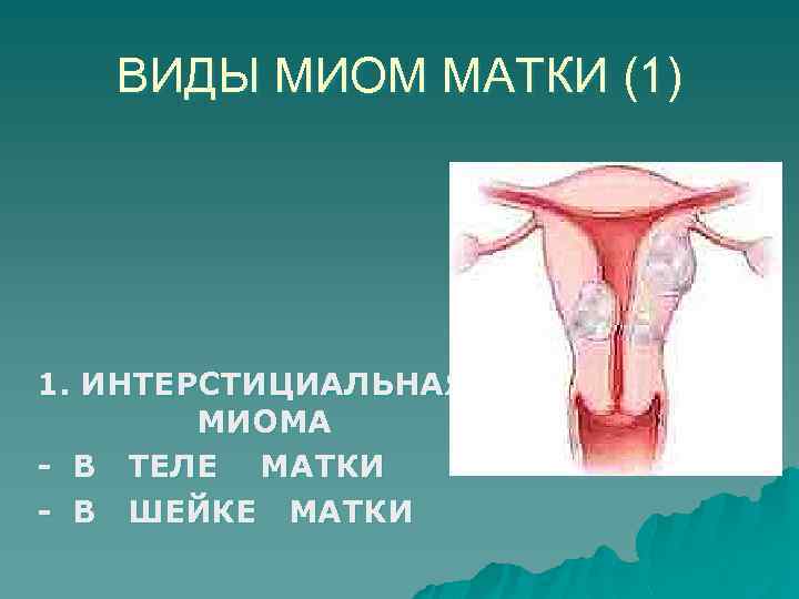 ВИДЫ МИОМ МАТКИ (1) 1. ИНТЕРСТИЦИАЛЬНАЯ МИОМА - В ТЕЛЕ МАТКИ - В ШЕЙКЕ