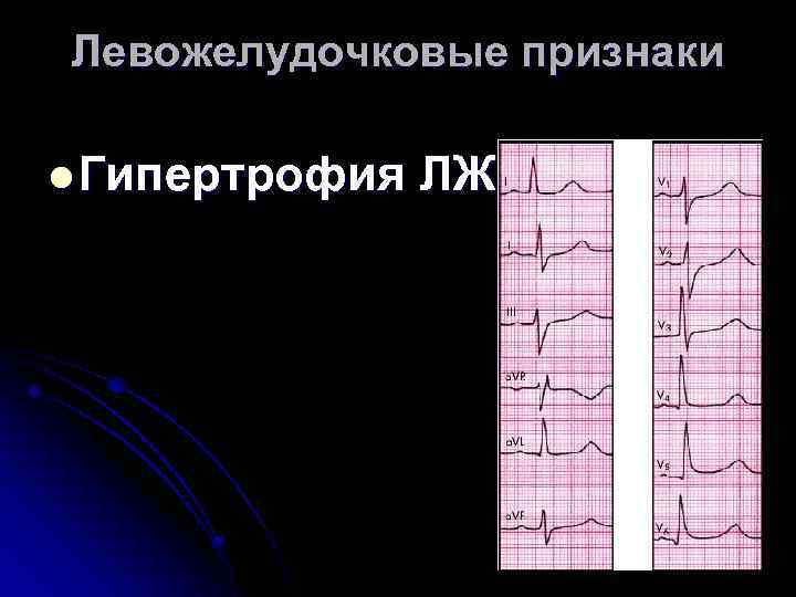 Левожелудочковые признаки l Гипертрофия ЛЖ 