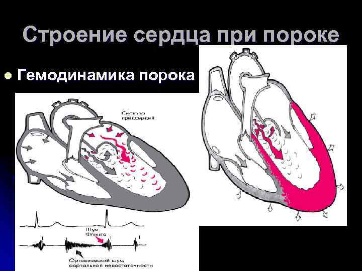 Строение сердца при пороке l Гемодинамика порока 