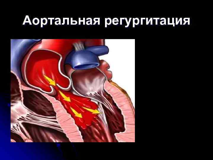 Аортальная регургитация 