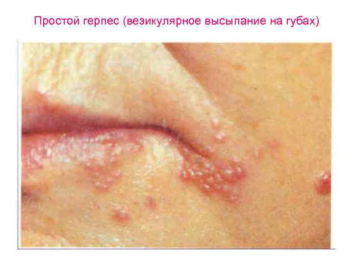 Простой герпес (везикулярное высыпание на губах) 