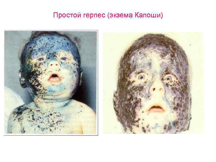 Простой герпес (экзема Капоши) 