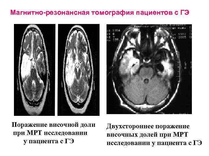  Магнитно-резонансная томография пациентов с ГЭ Поражение височной доли Двухстороннее поражение Поражение височной доли