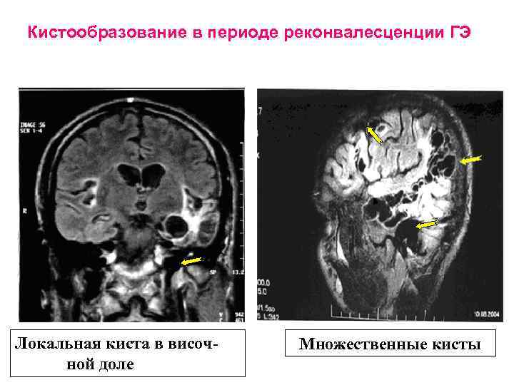 Кистообразование в периоде реконвалесценции ГЭ Локальная киста в височной доле Множественные кисты 