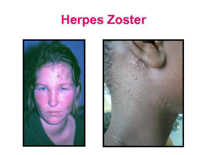 Herpes Zoster 