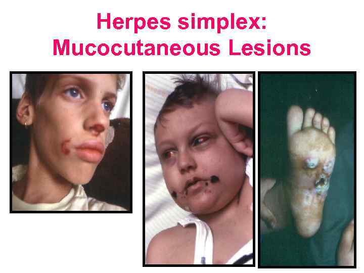 Herpes simplex: Mucocutaneous Lesions 