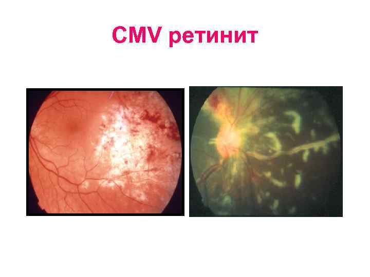 CMV ретинит 