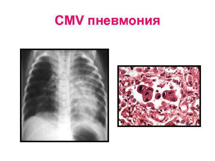 CMV пневмония 
