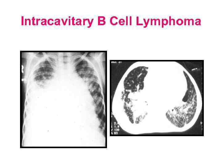 Intracavitary B Cell Lymphoma 