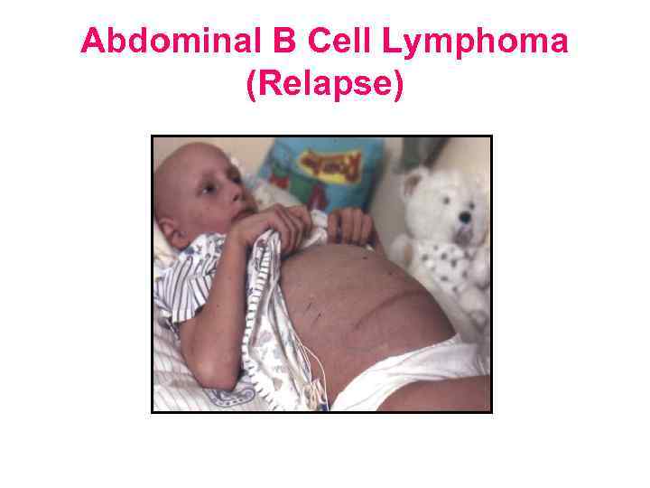 Abdominal B Cell Lymphoma (Relapse) 