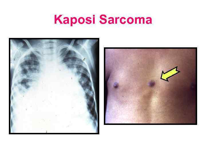 Kaposi Sarcoma 
