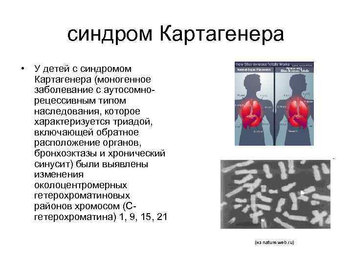 синдром Картагенера • У детей с синдромом Картагенера (моногенное заболевание с аутосомнорецессивным типом наследования,