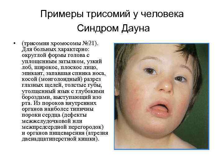Примеры трисомий у человека Синдром Дауна • (трисомия хромосомы № 21). Для больных характерно:
