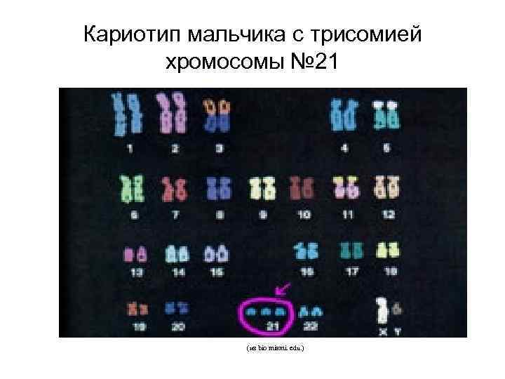 Кариотип мальчика с трисомией хромосомы № 21 (из bio miami. edu. ) 