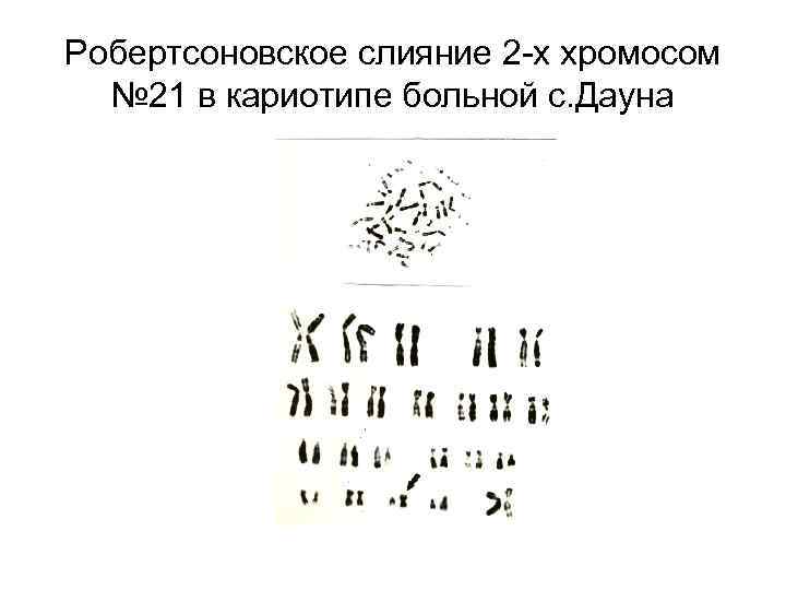 Робертсоновское слияние 2 -х хромосом № 21 в кариотипе больной с. Дауна 